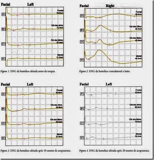 ACUPUNTURA CURITIBA PARALISIA FACIAL 2