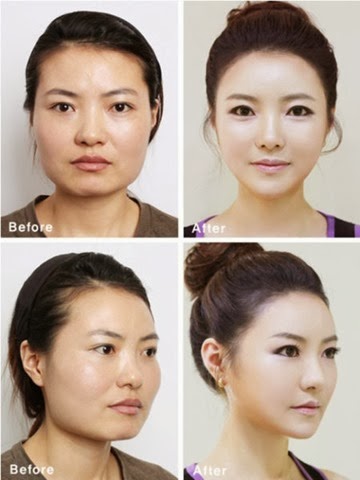 [korean-plastic-surgery-22%255B2%255D.jpg]