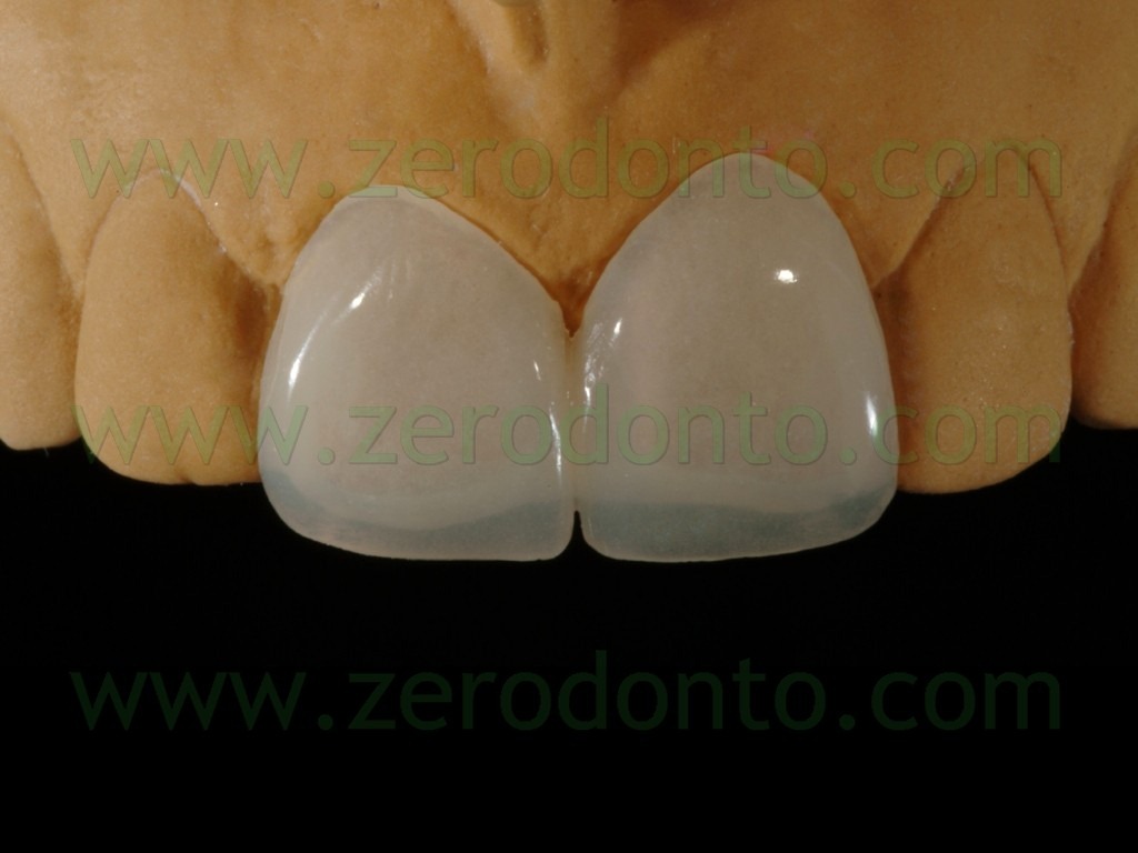 [42-veneers-provvisorie3.jpg]