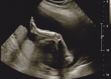 2012-01-11 ultrasound 4