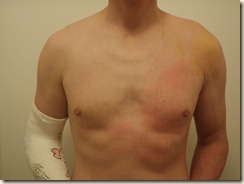 Brian's body after 1 week II Brian's body after 1 week II