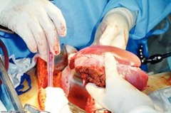 4-1-2-liver-transplant