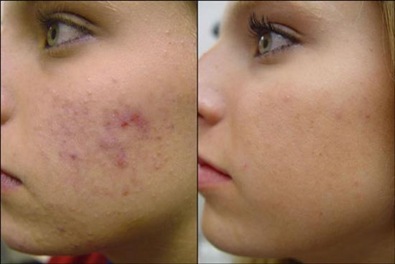 tratamientos para el acne peeling