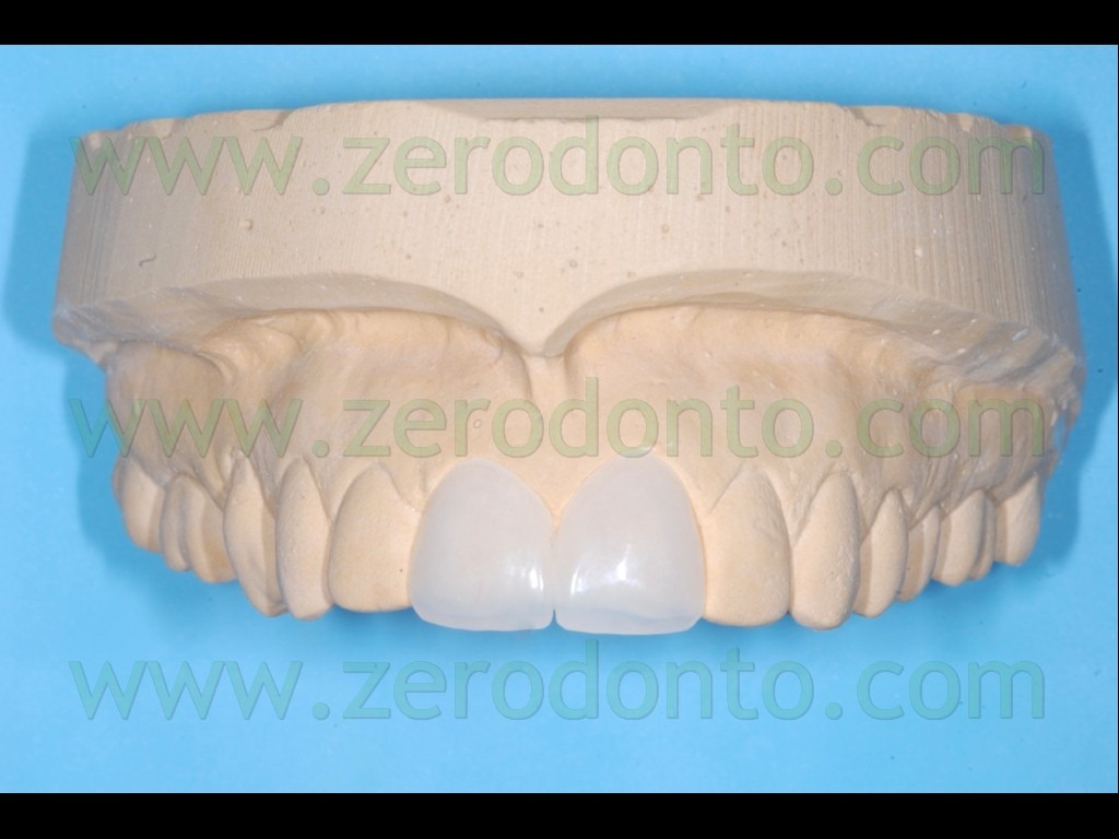 [22-previsualizzazione-veneer3.jpg]