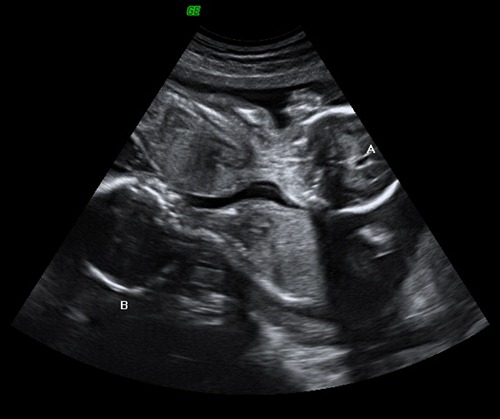 BABY GIRL TWINS_45 BABY GIRL TWINS_45