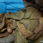 gall_bladder_L.JPG