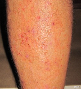 Allergie_an_Bein Allergie_an_Bein