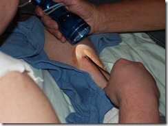 fish-hook in leg 05-24-11 005 fish-hook in leg 05-24-11 005