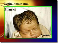 bilateralcephalotoma