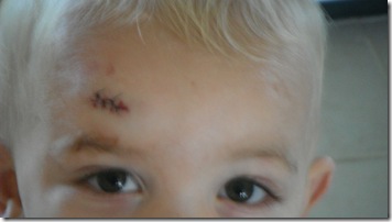 Kaleb's First Stitches 258