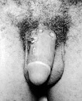 pene-infectado-sifilis.jpg
