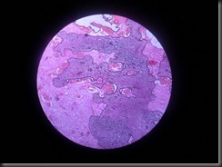 osteosarcoma high resolution histology slide tsnaps osteosarcoma high resolution histology slide tsnaps