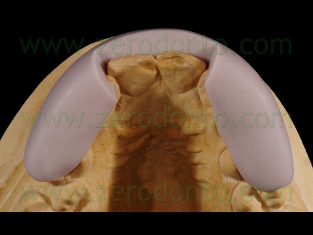 [39-faccette-mascherina-silicone3.jpg]