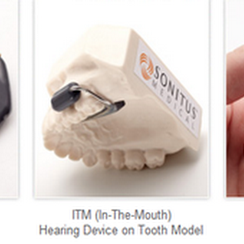 SoundBite Hearing System Receives FDA Clearance for Hearing Device That Attaches to Your Teeth