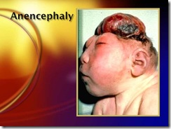 anencephaly
