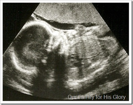 The Pain of Miscarriage
