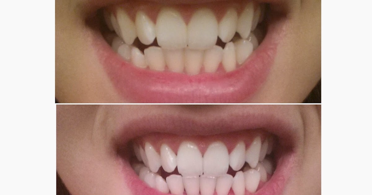 Simply Skincare Activated Charcoal Teeth Whitening!
