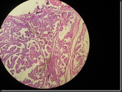 papillary CA thyroid high resolution histology slide tsnaps papillary CA thyroid high resolution histology slide tsnaps