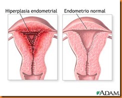 Câncer-de-Endométrio-2 Câncer-de-Endométrio-2