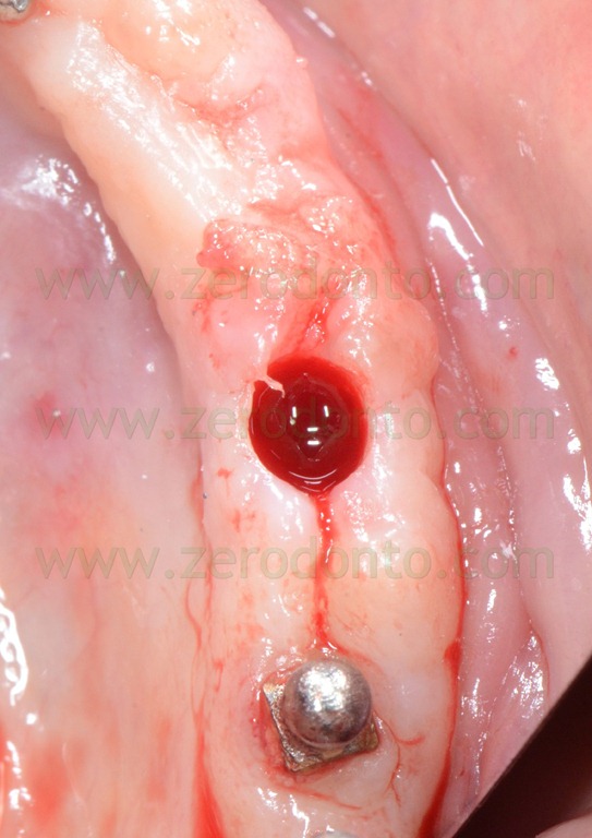 [--164-mucotomia3.jpg]