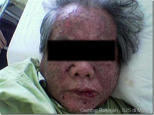 Steven Johnson Sindrome_Adverse Drugs Reaction _Face Steven Johnson Sindrome_Adverse Drugs Reaction _Face