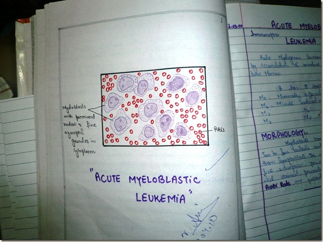 AML blood film- acute myeloblastic leukemia - hand made haematology diagram