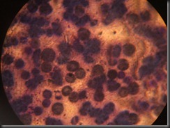 AML high resolution histology slide tsnaps AML high resolution histology slide tsnaps