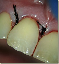 Sutures pic021