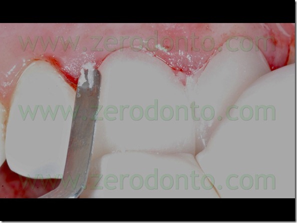 76 ribasatura veneers provvisorie