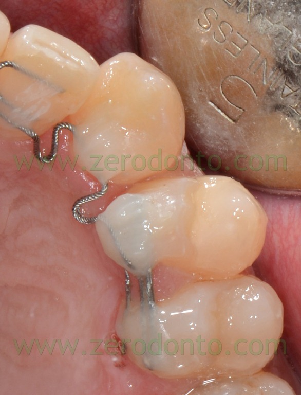 [22%2520denti%2520storti%2520bis%255B4%255D.jpg]