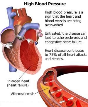 [information-on-high-blood-pressure%255B4%255D.jpg]