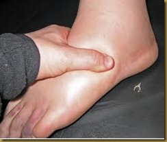 edema edema