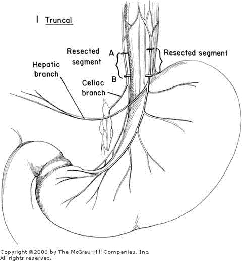 Zollinger Atlas of Surgery: VAGOTOMY