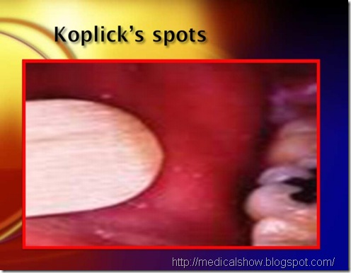 koplick's spots