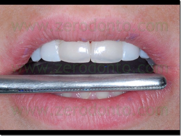 81 articolazione protrusiva veneers