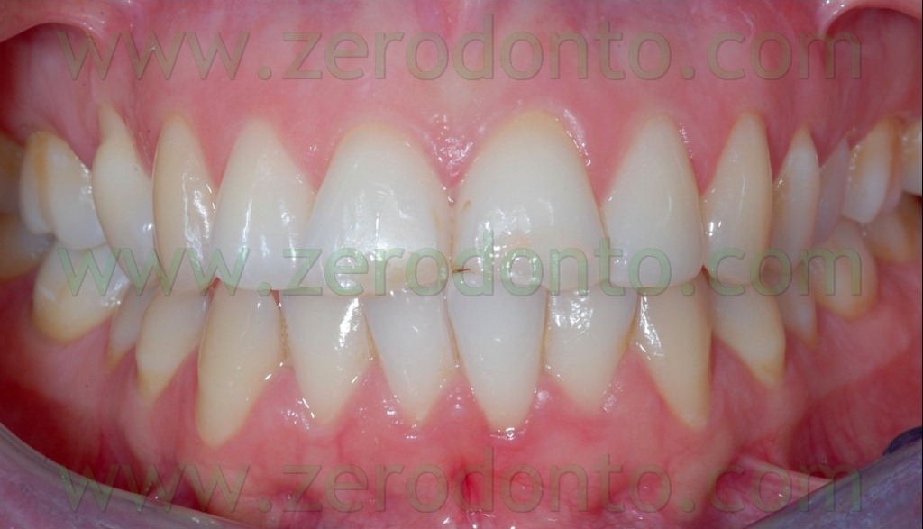 [3-occlusione-centrica4%255B3%255D.jpg]