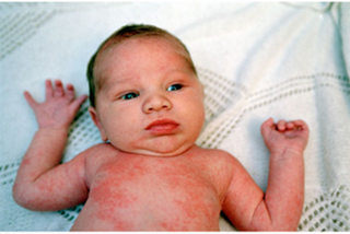 dermatitis-ruam-pada-tubuh-bayi.