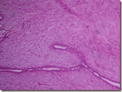 fibroadenoma slide photograph