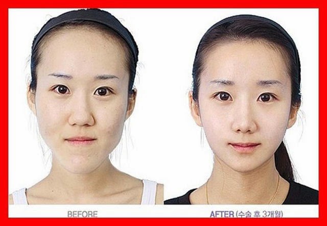 [korean-plastic-surgery-29%255B2%255D.jpg]