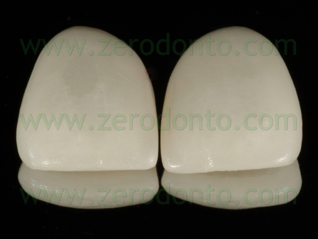 [95-faccette-ceramica-feldspatica3.jpg]