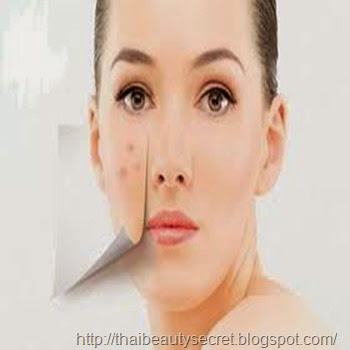 วิธีรักษาสิว ยารักษาสิว วิธีรักษาสิว ยารักษาสิว