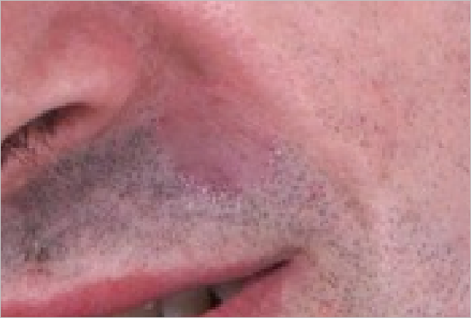 Removing acne in Photoshop Removing-acne-in-Photoshop