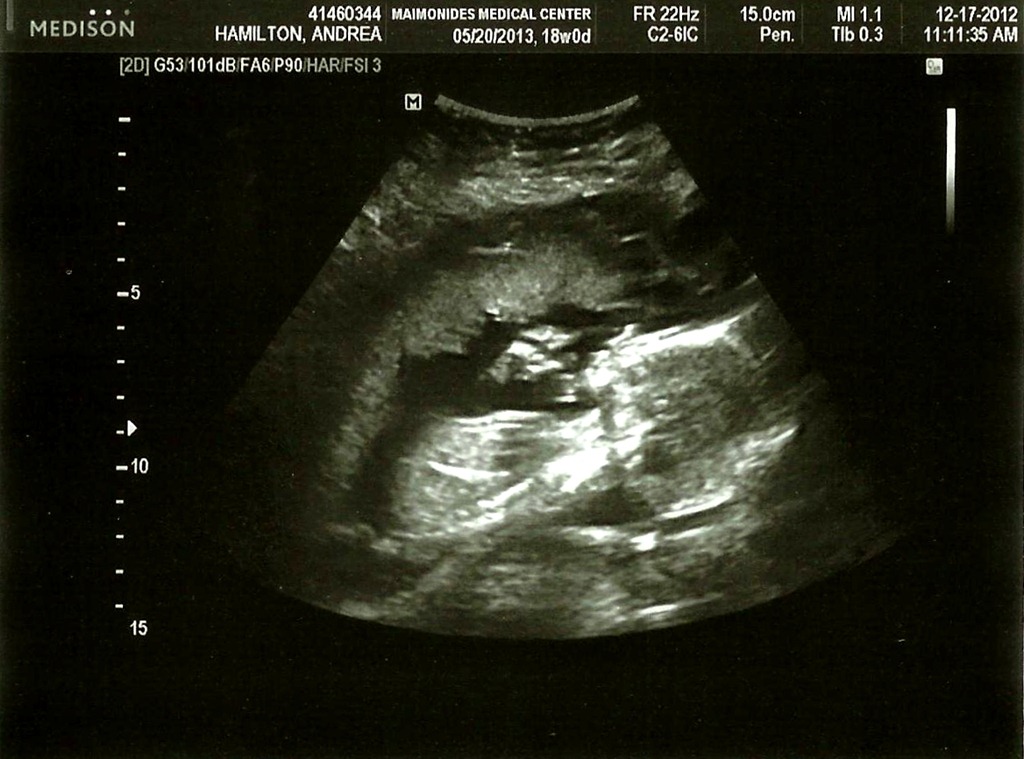 [Twin%2520A%2520Baby%2520Girl%252018%2520Weeks%255B3%255D.jpg]
