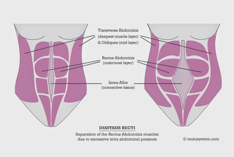 Diastasis recti Pictures