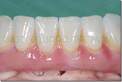 ceramica dedicata per zirconia
