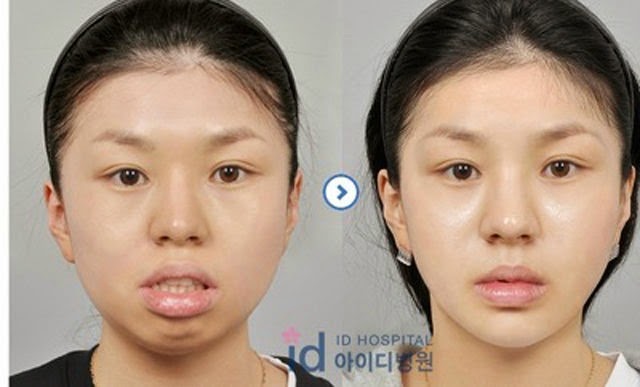 [korean-plastic-surgery-43%255B2%255D.jpg]