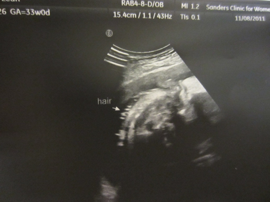 [Zoey%2520Nola%252033%2520Week%2520Sonogram3%255B4%255D.jpg]