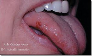عض اللسان عض اللسان