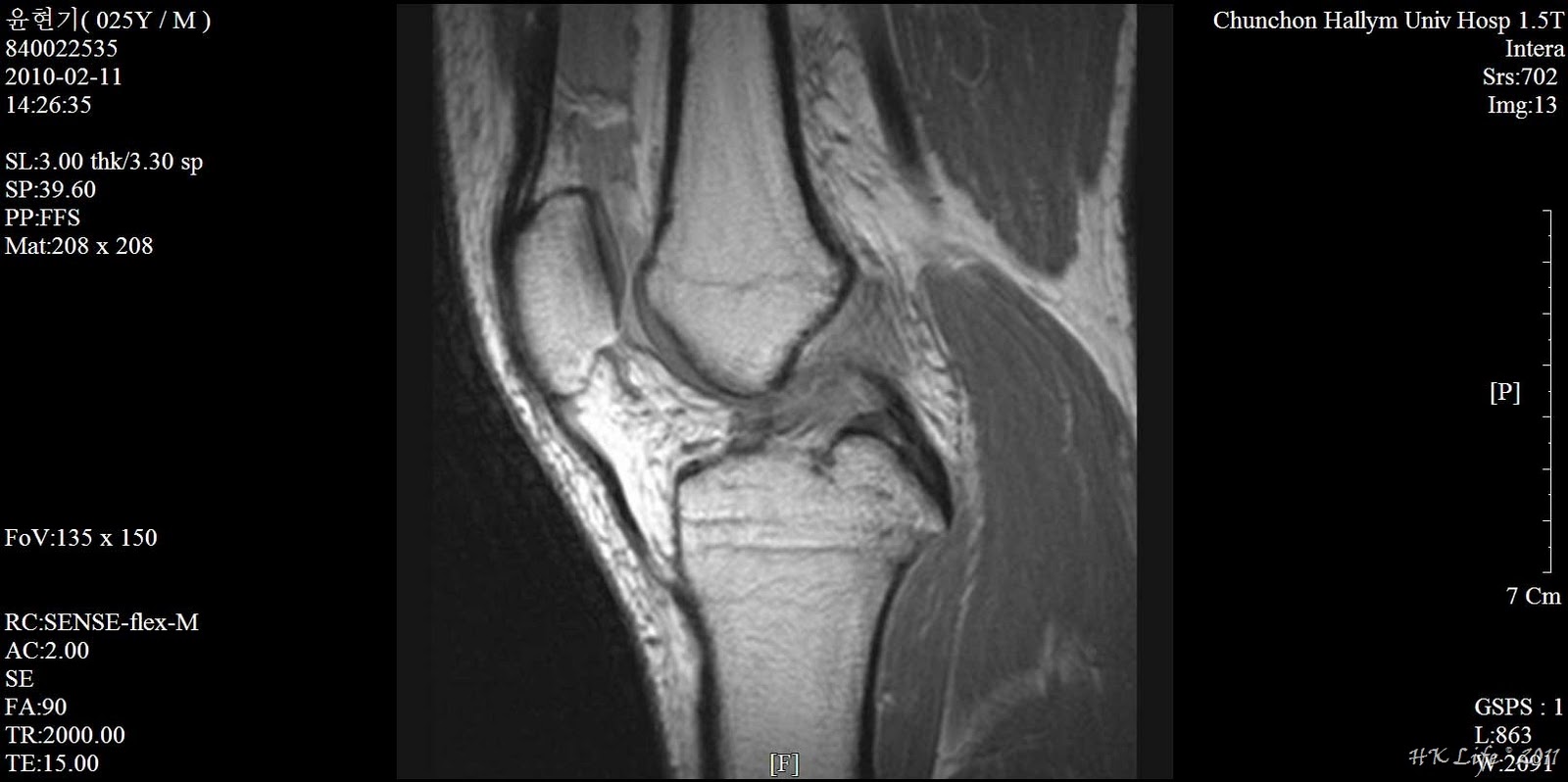 [01%2520knee%2520mri%255B8%255D.jpg]