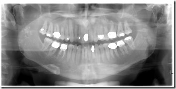 Bruce Winter PAN teeth from dentist